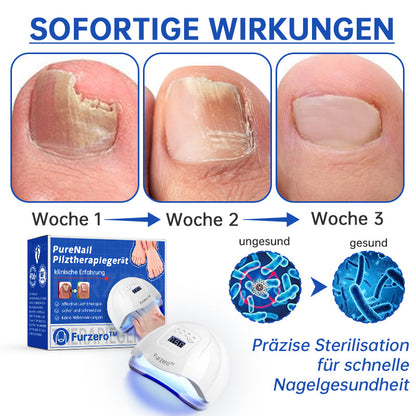 👍Furzero™ PureNail Pilz-Lasertherapiegerät