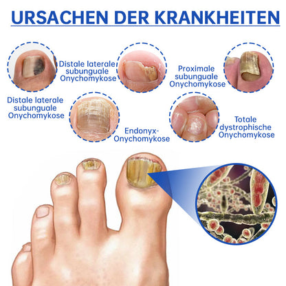 👍Furzero™ PureNail Pilz-Lasertherapiegerät