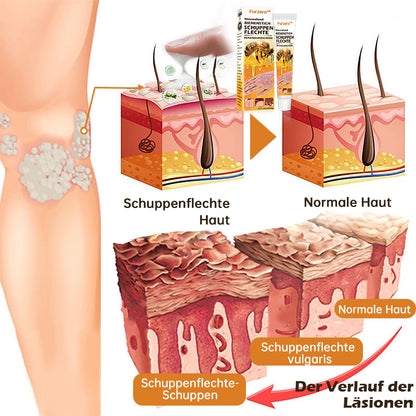 🐝Furzero™ Neuseeland Bienengift Psoriasis-Behandlungscreme (Geeignet für alle Hautbedingungen)