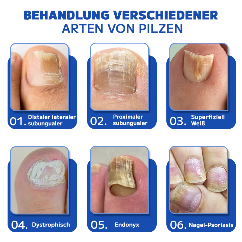 Furzero™ Pilzbehandlungs-Lasergerät für Nägel