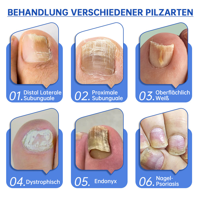 👍Furzero™ PureNail Pilz-Lasertherapiegerät